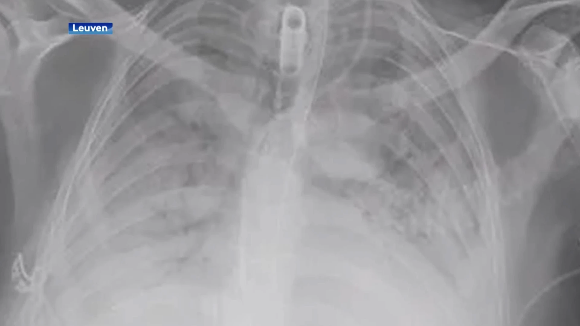 Eerste succesvolle longtransplantatie bij COVID-patiënt in UZ Leuven