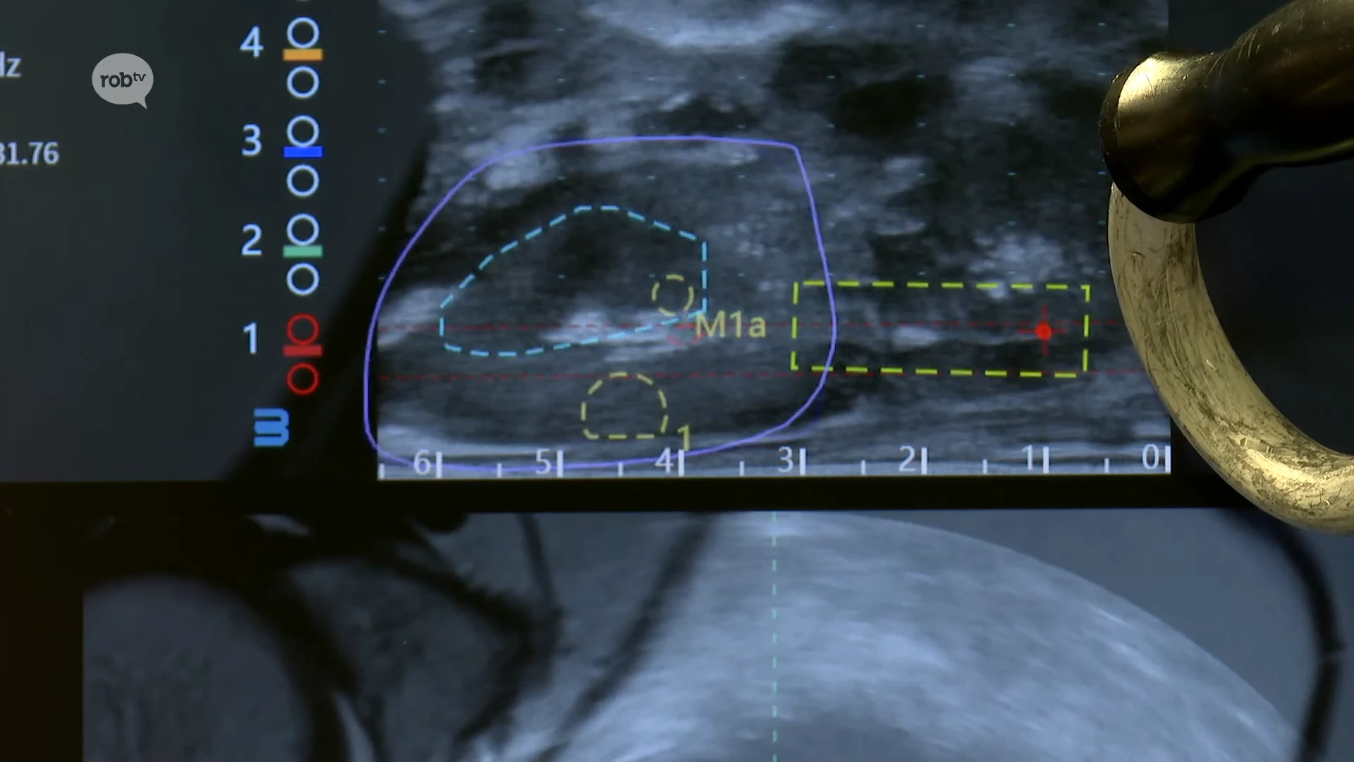 Hoofdafbeelding voor artikel PRIMEUR: nieuwe techniek voor…