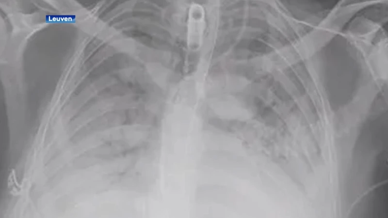Eerste succesvolle longtransplantatie bij COVID-patiënt in UZ Leuven