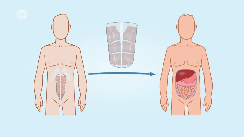 Primeur in België: UZ Leuven voert twee succesvolle buikwandtransplantaties uit