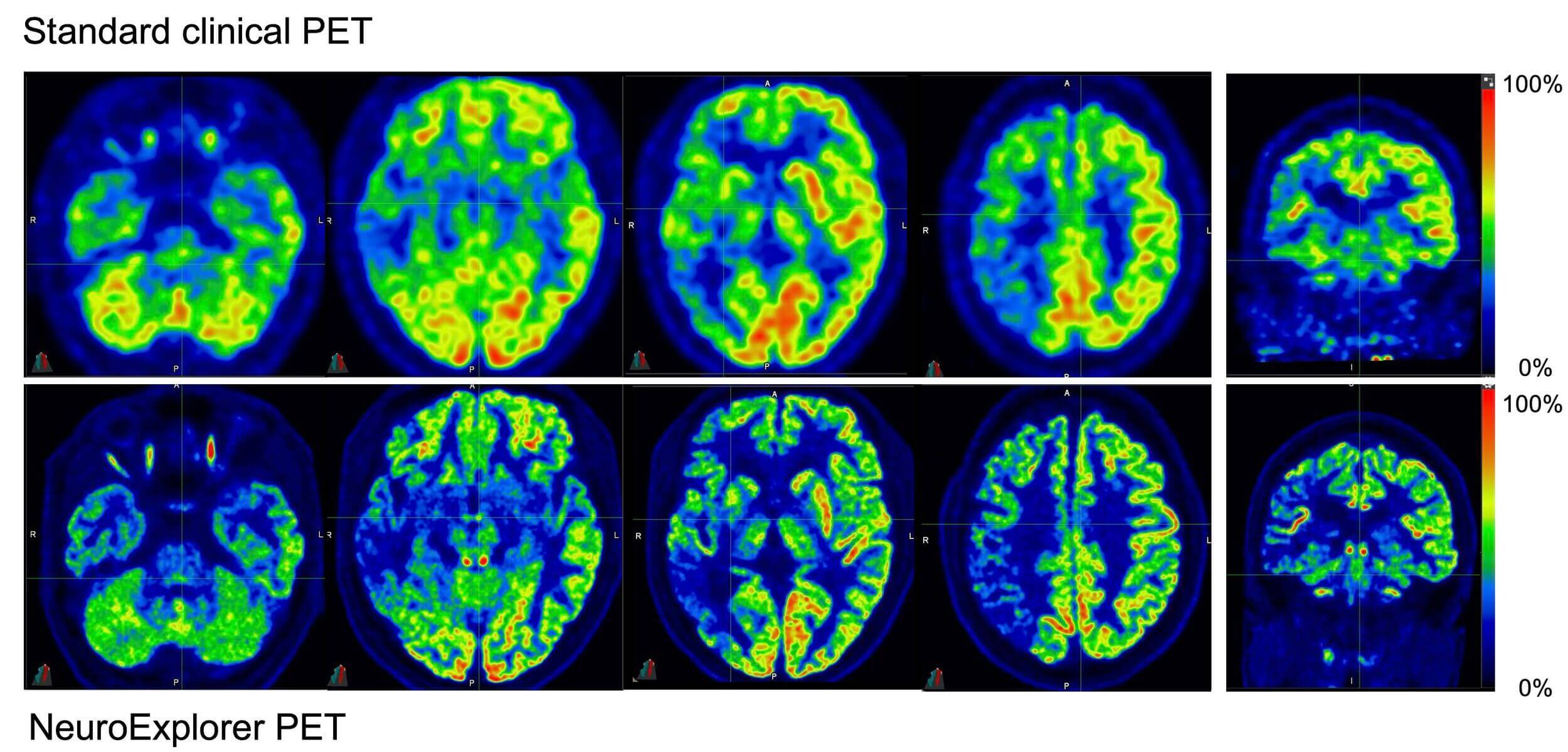 De nieuwe hersenscans (onder) ten opzichte van klassieke PET-scans (boven)